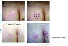 This recalcitrant psoriatic lesion resolved completely for 7 months after being injected with 30 units of abobotulinumtoxinA.
